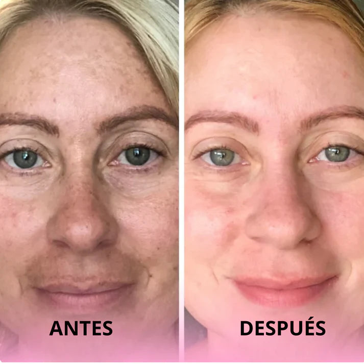 Discos anti-imperfecciones Glowker™ - Consigue una piel libre de manchas