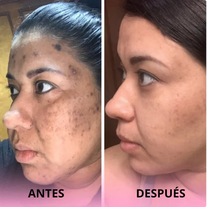 Discos anti-imperfecciones Glowker™ - Consigue una piel libre de manchas