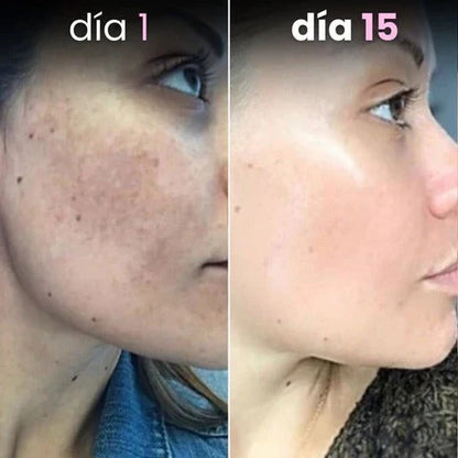 Discos anti-imperfecciones Glowker™ - Consigue una piel libre de manchas
